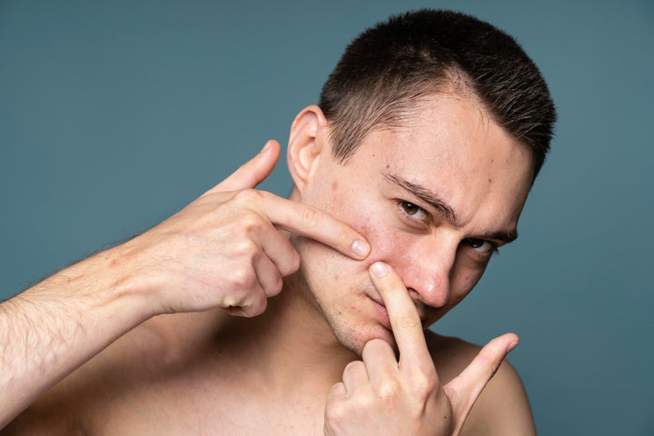 Acne and Pimples