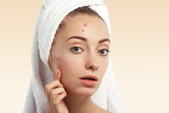 Adult acne